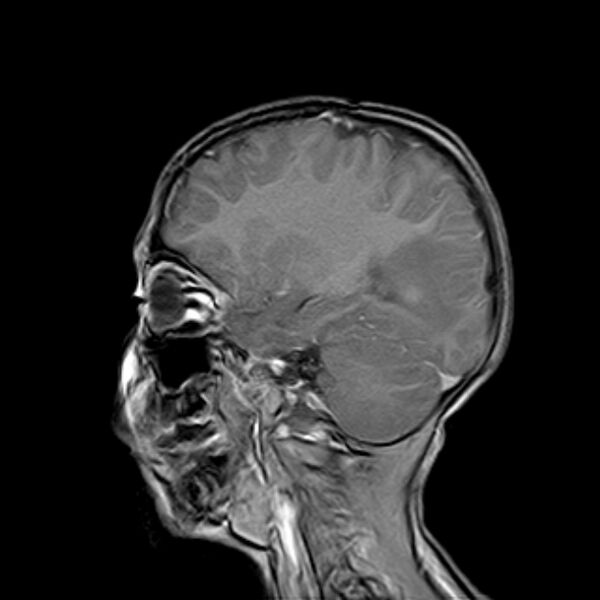 File:Cerebral tuberculoma (Radiopaedia 41152-43932 Sagittal T1 C+ 13).jpg