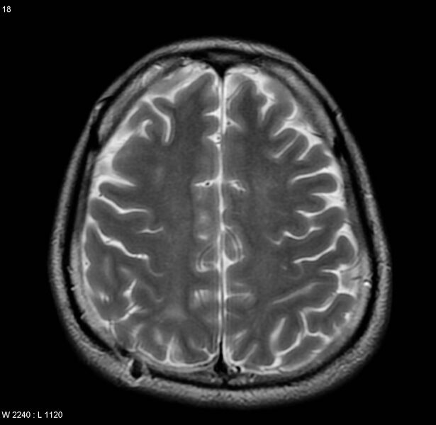 File:Cerebral vasculitis (Radiopaedia 5131-6923 Axial T2 9).jpg