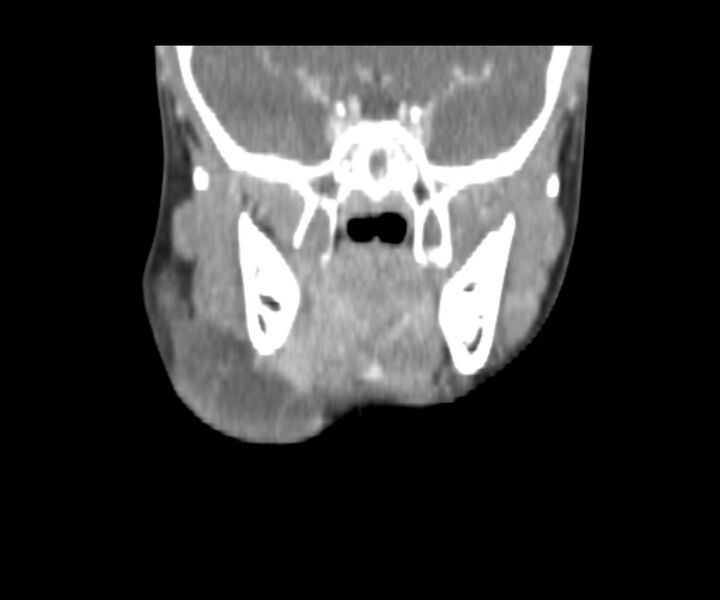 File:Cervical cystic lymphangioma (Radiopaedia 63655-72332 Coronal + contrast 16).jpg