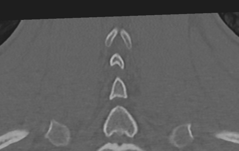File:Cervical disc replacement (Radiopaedia 37383-39205 Coronal bone window 52).png