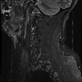 Cervical flexion teardrop fracture with cord hemorrhage (Radiopaedia 32497-33455 Sagittal STIR 18).jpg
