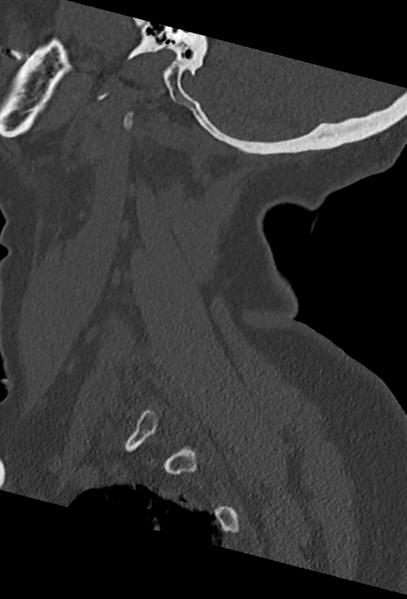 File:Cervical spine ACDF loosening (Radiopaedia 48998-54070 Sagittal bone window 20).png