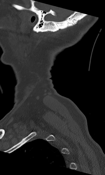File:Cervical spine fracture - chalk stick (Radiopaedia 39116-41323 Sagittal bone window 1).png