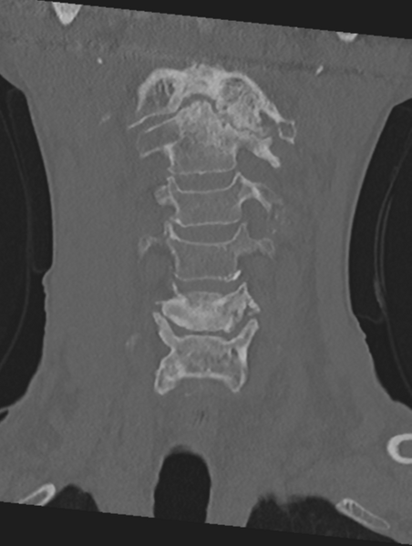File:Cervical spondylolysis (Radiopaedia 49616-54811 Coronal bone window 13).png