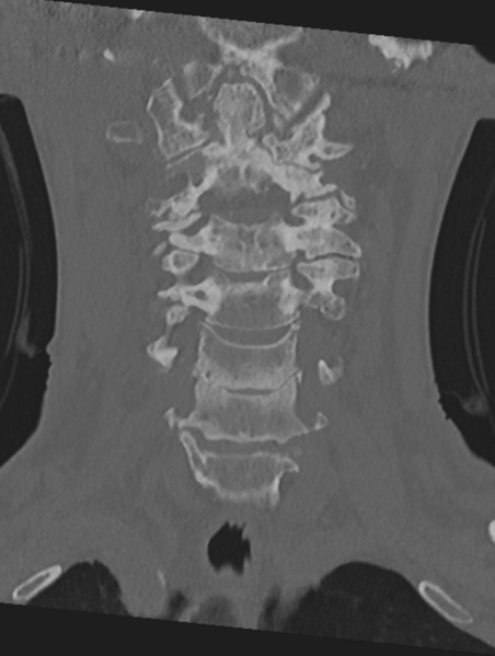 File:Cervical spondylolysis (Radiopaedia 49616-54811 Coronal bone window 18).png