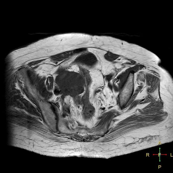 File:Cervical stump squamous cell carcinoma (Radiopaedia 48049-52858 Axial T1 13).jpg
