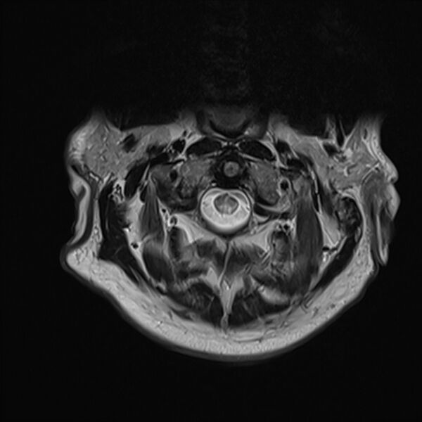 File:Cervical tumor-like myelopathy due to Type V dAVF (Radiopaedia 82461-96604 Axial T2 5).jpg