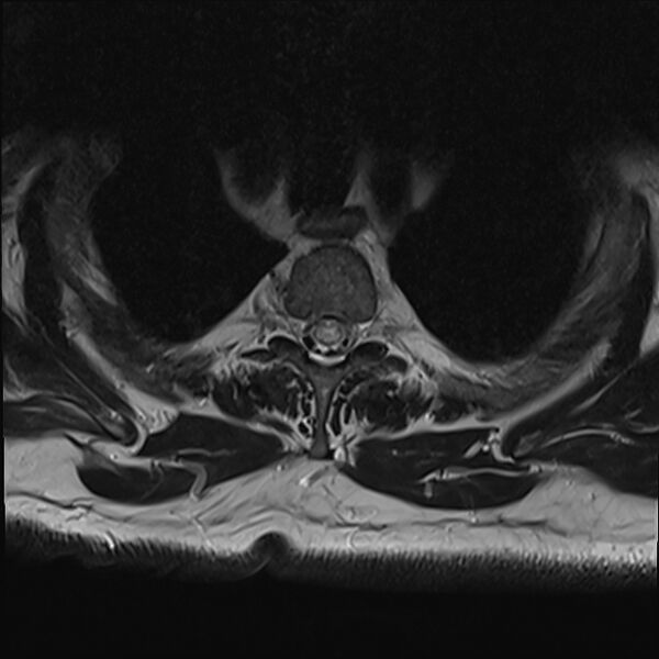 File:Cervical tumor-like myelopathy due to Type V dAVF (Radiopaedia 82461-96604 D 4).jpg