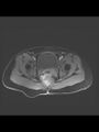 Cesarean section scar endometrioma (Radiopaedia 56569-63297 Axial T1 C+ fat sat 12).jpg