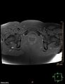 Cesarian scar endometriosis (Radiopaedia 68495-78066 Axial T1 fat sat 22).jpg