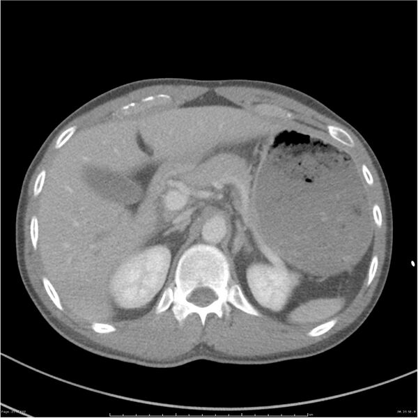 File:Chest and abdomen multi-trauma (Radiopaedia 26294-26426 bone window 25).jpg