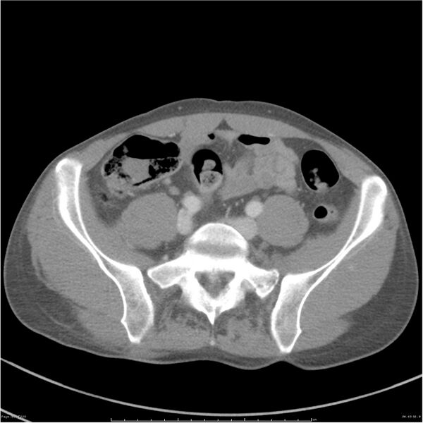 File:Chest and abdomen multi-trauma (Radiopaedia 26294-26426 bone window 63).jpg