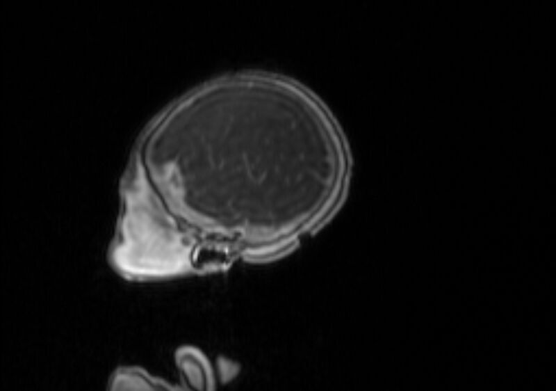 File:Chiari III malformation with occipital encephalocele (Radiopaedia 79446-92559 Sagittal T1 C+ mpr 57).jpg