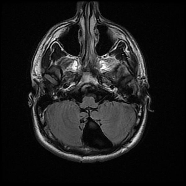 File:Chiasmatic-hypothalamic juvenile pilocytic astrocytoma (Radiopaedia 78533-91235 Axial FLAIR 7).jpg