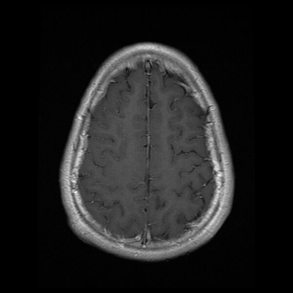 File:Chiasmatic-hypothalamic juvenile pilocytic astrocytoma (Radiopaedia 78533-91236 Axial T1 C+ 23).jpg