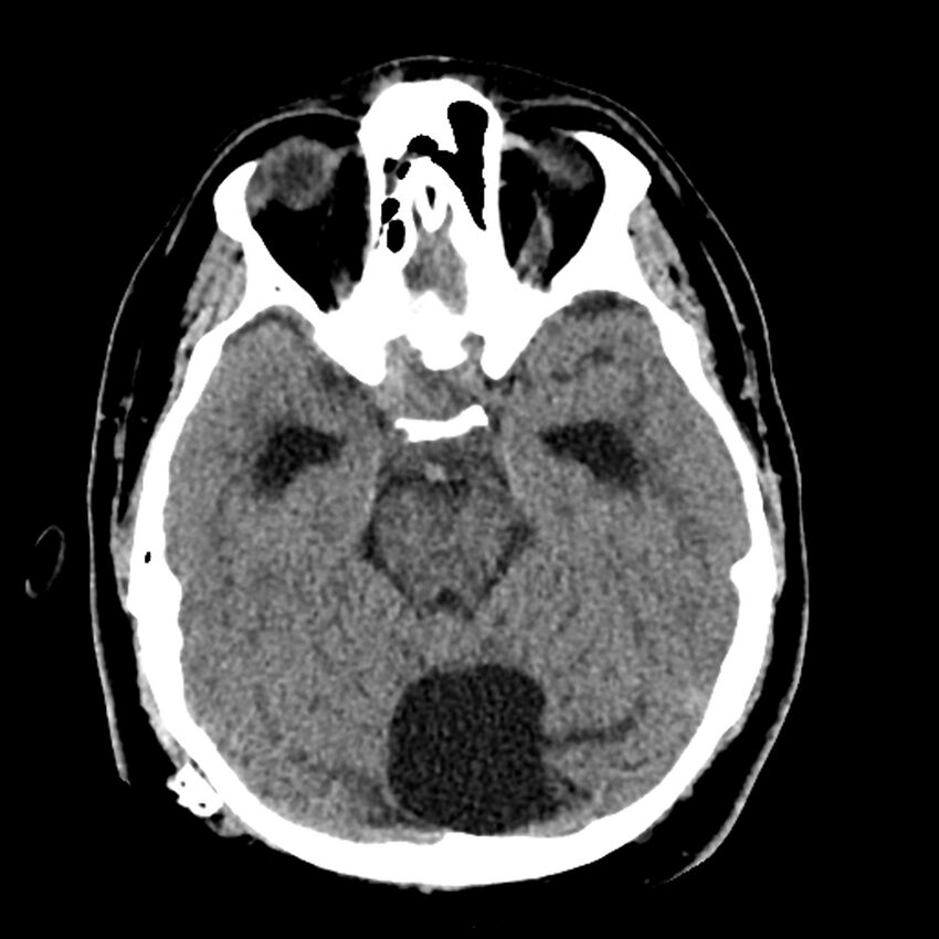 Chiasmatic-hypothalamic juvenile pilocytic astrocytoma (Radiopaedia 78533-91237 Axial non-contrast 21).jpg