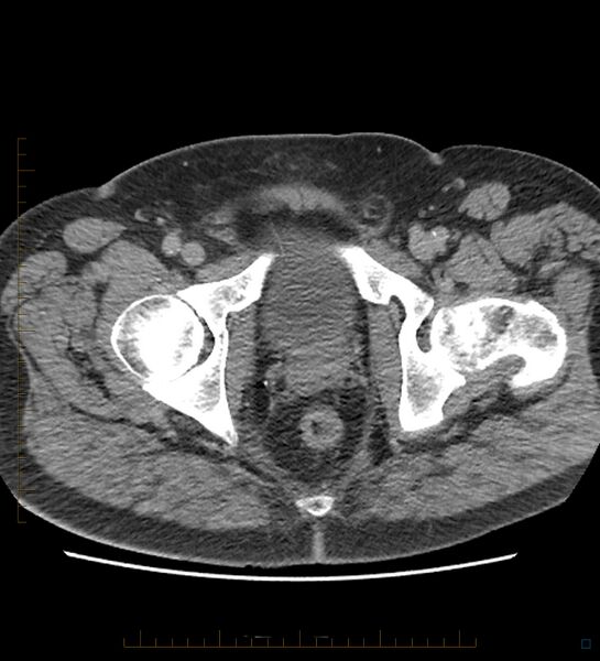 File:Chicken bone in anal canal (Radiopaedia 51490-57253 Axial non-contrast 7).jpg