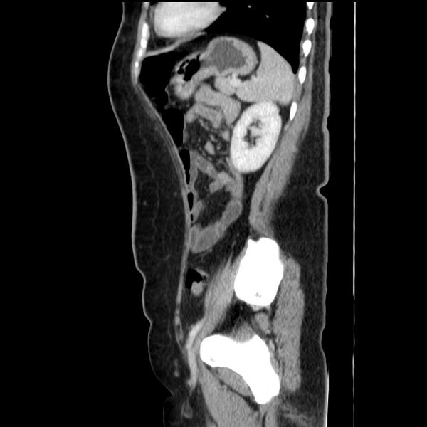 File:Choledocholithiasis on CT and MRI (Radiopaedia 24825-25087 D 46).jpg