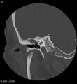 Cholesteatoma (Radiopaedia 5467-7197 Coronal bone window 5).jpg