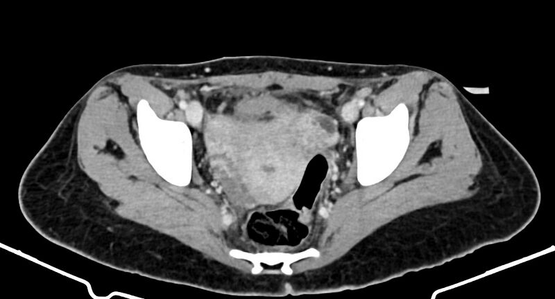 File:Choriocarcinoma liver metastases (Radiopaedia 74768-85766 A 182).jpg