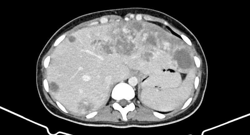 File:Choriocarcinoma liver metastases (Radiopaedia 74768-85766 A 45).jpg