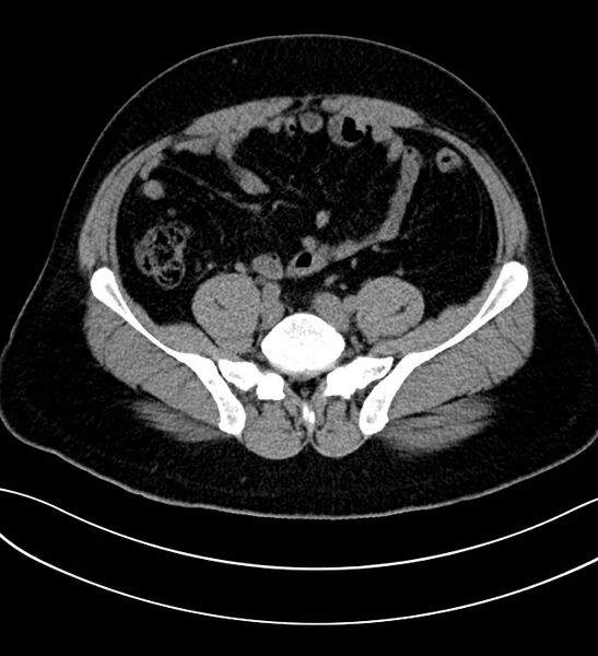 File:Chromophobe renal cell carcinoma (Radiopaedia 84286-99573 Axial non-contrast 43).jpg