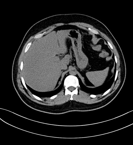 File:Chromophobe renal cell carcinoma (Radiopaedia 84286-99573 Axial non-contrast 6).jpg