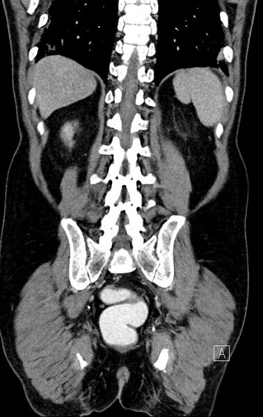 File:Chronic appendicitis complicated by appendicular abscess, pylephlebitis and liver abscess (Radiopaedia 54483-60700 C 65).jpg