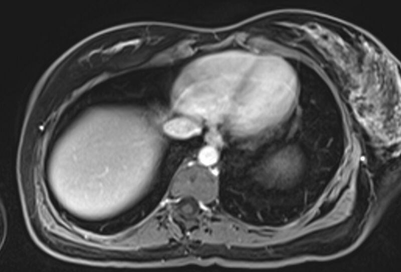 File:Chronic pancreatitis - pancreatic duct calculi (Radiopaedia 71818-82250 Axial T1 C+ fat sat 3).jpg