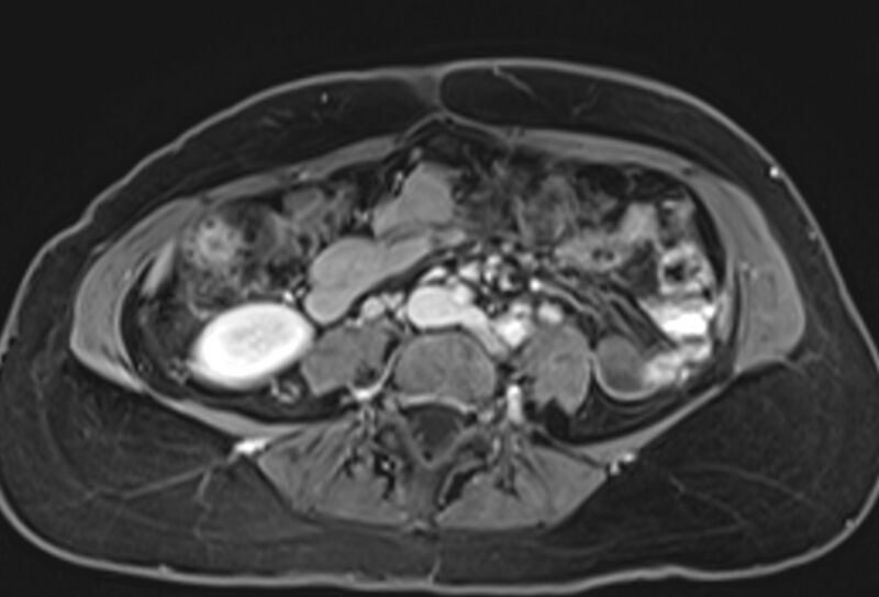 File:Chronic pancreatitis - pancreatic duct calculi (Radiopaedia 71818-82250 Axial T1 C+ fat sat 54).jpg