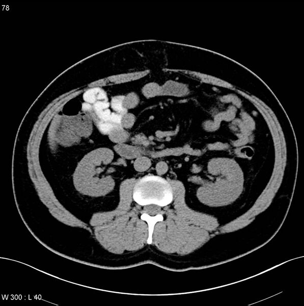File:Chronic pancreatitis and pseudocysts (Radiopaedia 6724-7935 Axial non-contrast 16).jpg