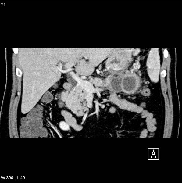 File:Chronic pancreatitis and pseudocysts (Radiopaedia 6724-7935 C 6).jpg