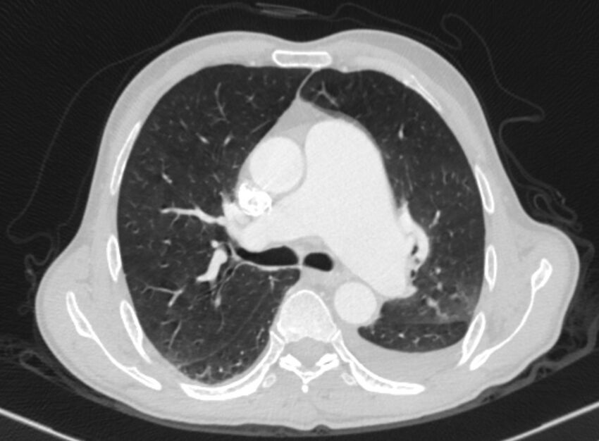 Chronic pulmonary embolism with bubbly consolidation (Radiopaedia 91248-108850 Axial lung window 68).jpg