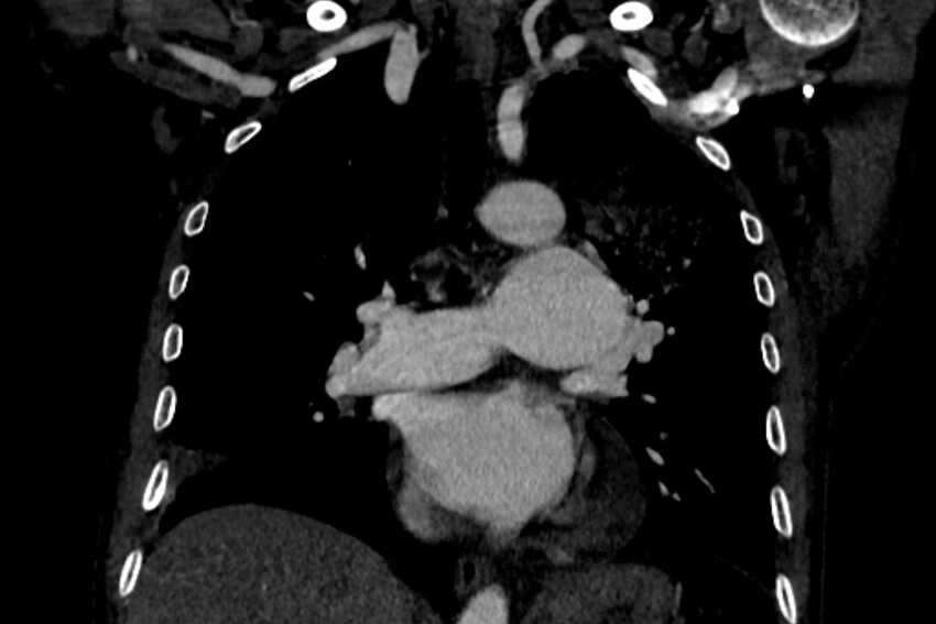 Chronic pulmonary embolism with bubbly consolidation (Radiopaedia 91248-108850 B 74).jpg