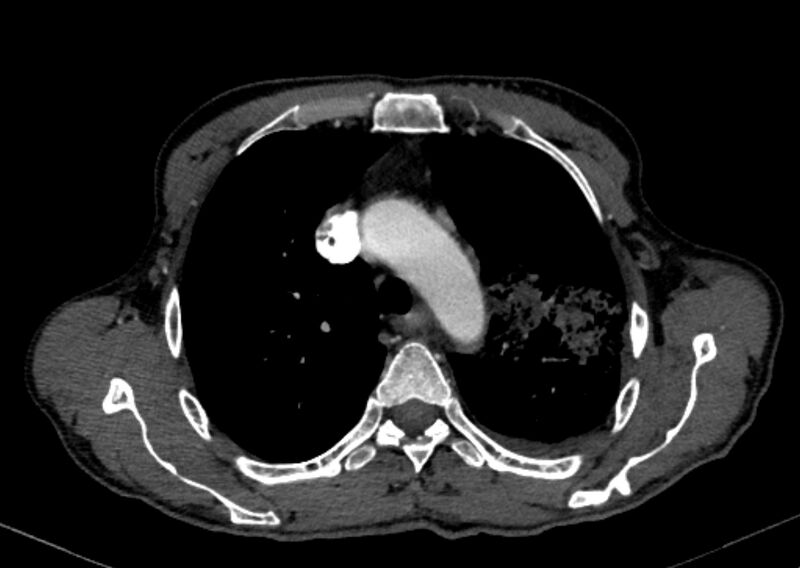 File:Chronic pulmonary embolism with bubbly consolidation (Radiopaedia 91248-108850 C+ arterial phase 34).jpg