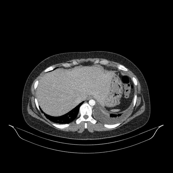 File:Chronic thromboembolic pulmonary hypertension (CTEPH) (Radiopaedia 74597-85532 Axial C+ CTPA 28).jpg