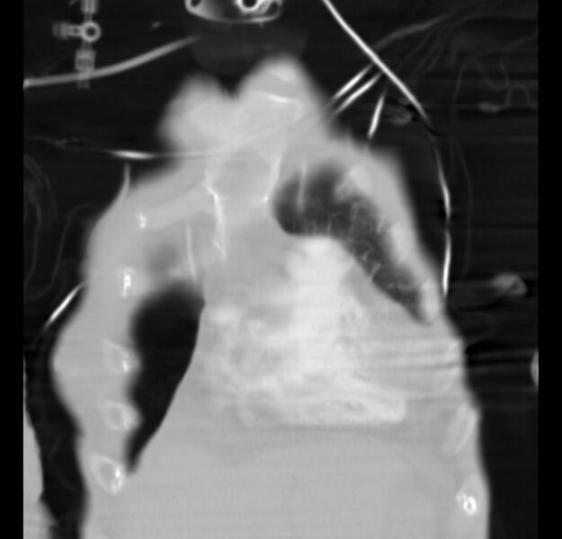 File:Clagett thoracotomy with bronchopleural fistula (Radiopaedia 29192-29587 Coronal lung window 27).jpg