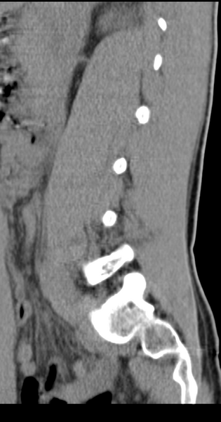 File:Clear cell meningoma - lumbar spine (Radiopaedia 60116-67691 A 32).png