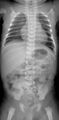 Cleidocranial dysostosis (Radiopaedia 11319-11683 A 1).jpg
