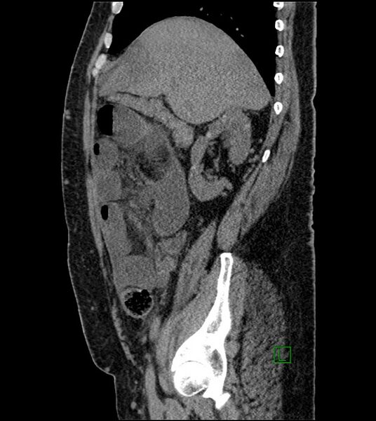 File:Closed-loop small bowel obstruction-internal hernia (Radiopaedia 78439-91096 C 101).jpg