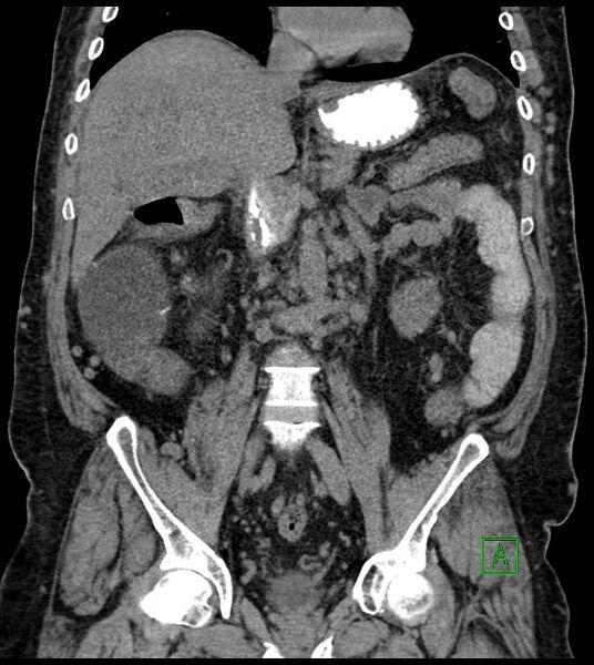 File:Closed-loop small bowel obstruction-internal hernia (Radiopaedia 78439-91096 Coronal non-contrast 56).jpg