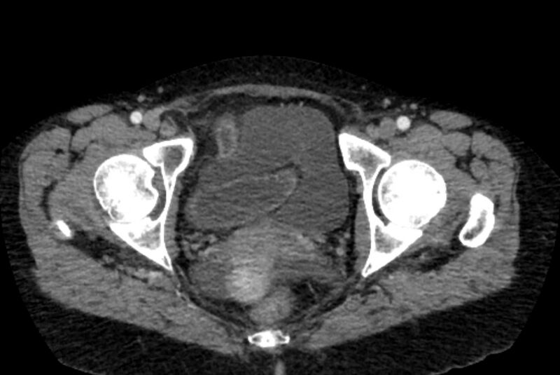 File:Closed loop small bowel obstruction (Radiopaedia 71211-81508 A 163).jpg
