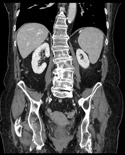 File:Closed loop small bowel obstruction - adhesions (Radiopaedia 59269-66611 B 82).jpg