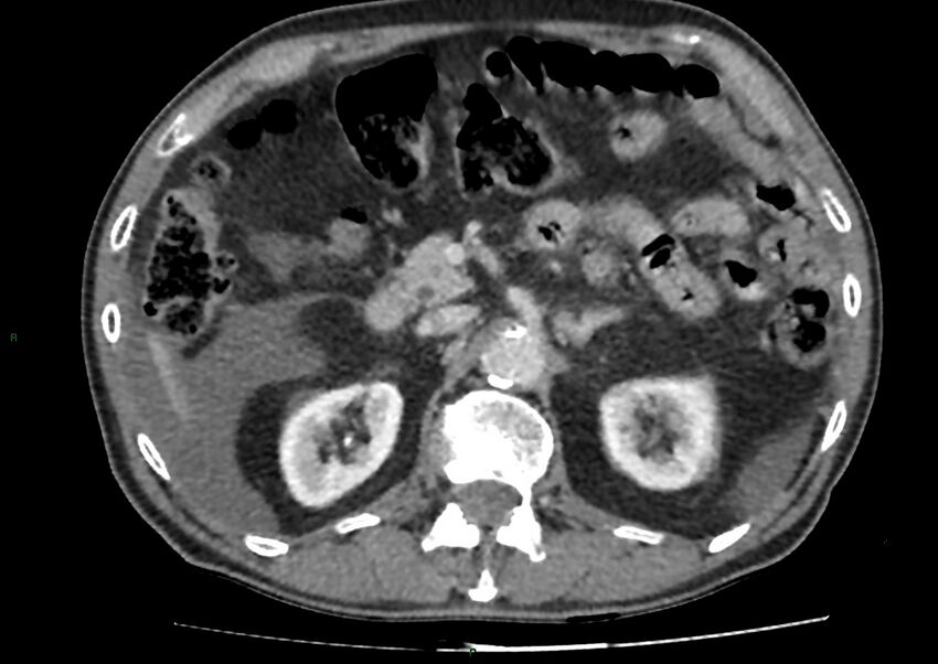 Closed loop small bowel obstruction with ischemia (Radiopaedia 84180-99456 A 39).jpg