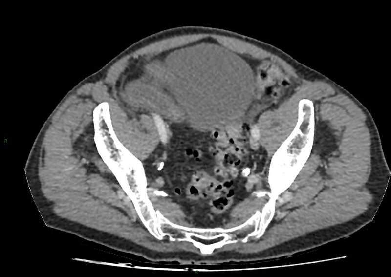 File:Closed loop small bowel obstruction with ischemia (Radiopaedia 84180-99456 A 99).jpg