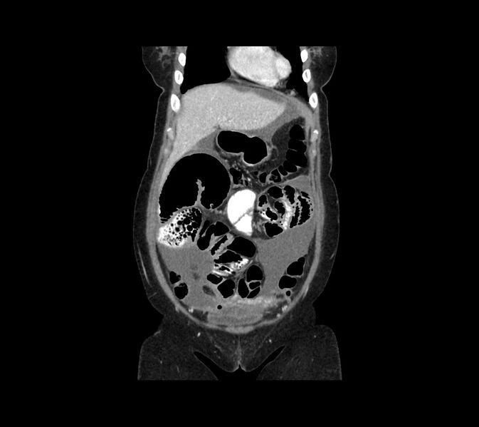File:Cocoon abdomen with possible tubo-ovarian abscess (Radiopaedia 46235-50636 B 12).jpg