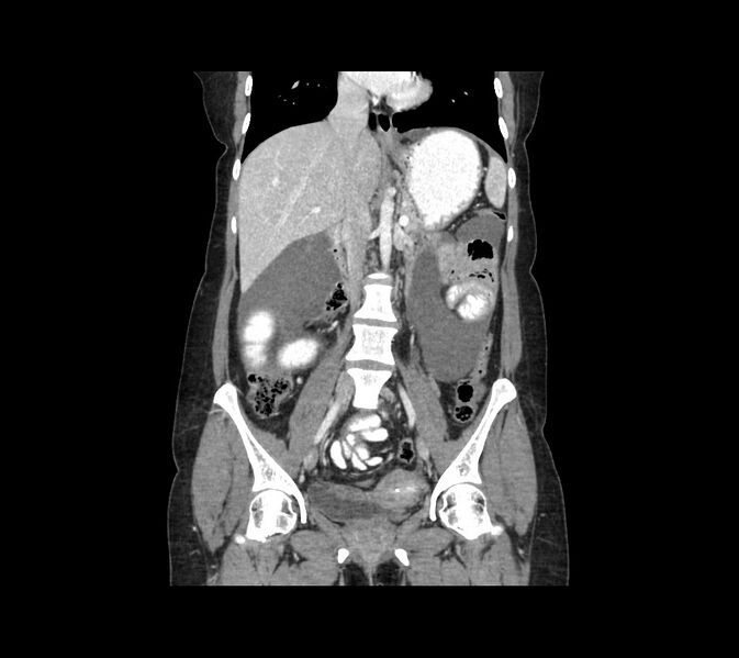 File:Cocoon abdomen with possible tubo-ovarian abscess (Radiopaedia 46235-50636 B 28).jpg