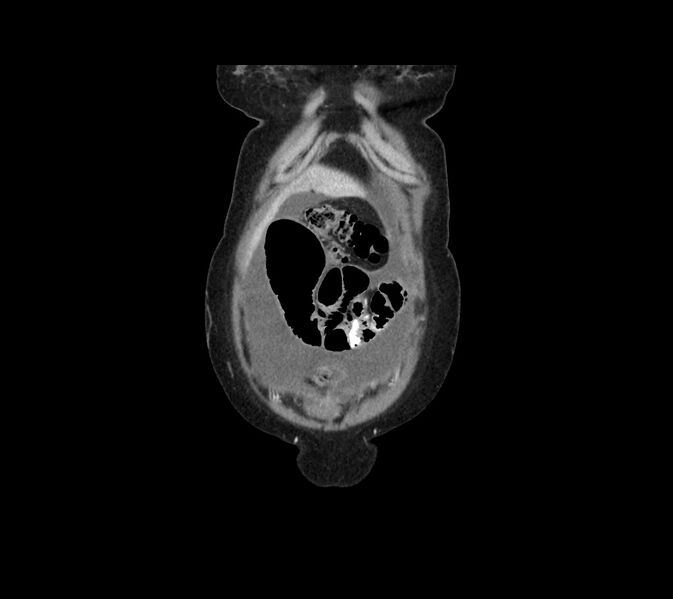 File:Cocoon abdomen with possible tubo-ovarian abscess (Radiopaedia 46235-50636 B 6).jpg