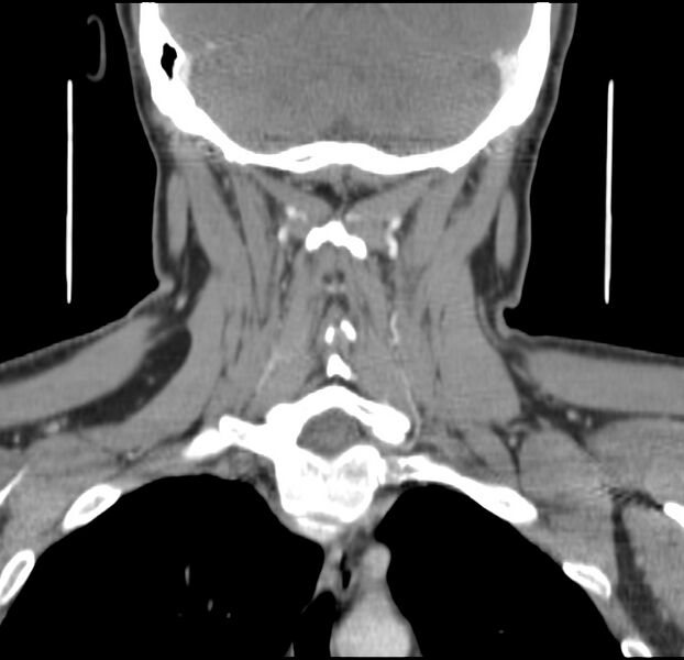 File:Colloid cyst of thyroid (Radiopaedia 22897-22923 Coronal C+ delayed 45).jpg