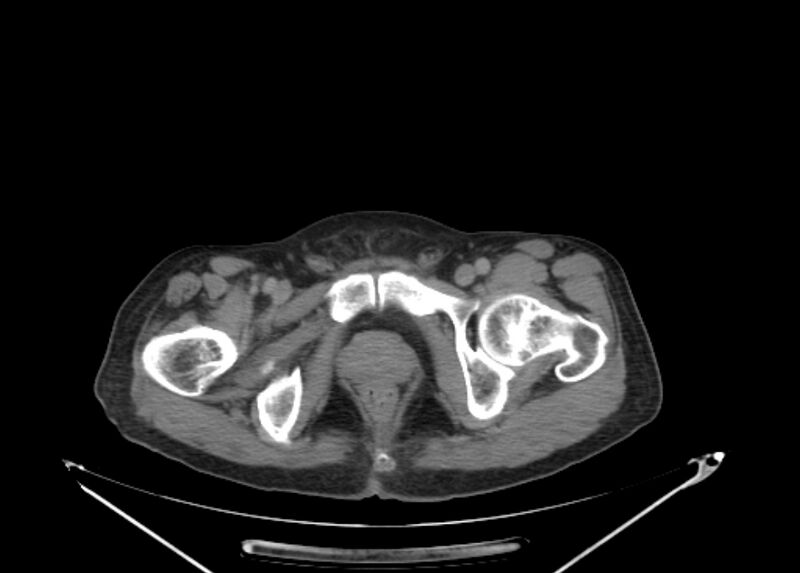 File:Colon cancer mimicking renal cell carcinoma (Radiopaedia 28986-29335 Axial C+ delayed 79).jpg